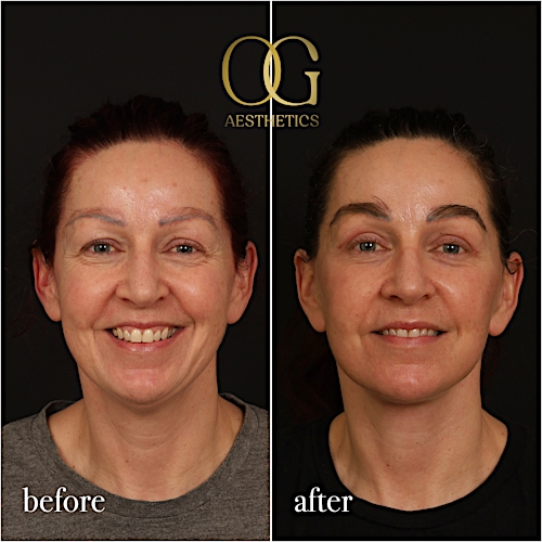 Fat Transfer Before & After Gallery - Patient 229052 - Image 2