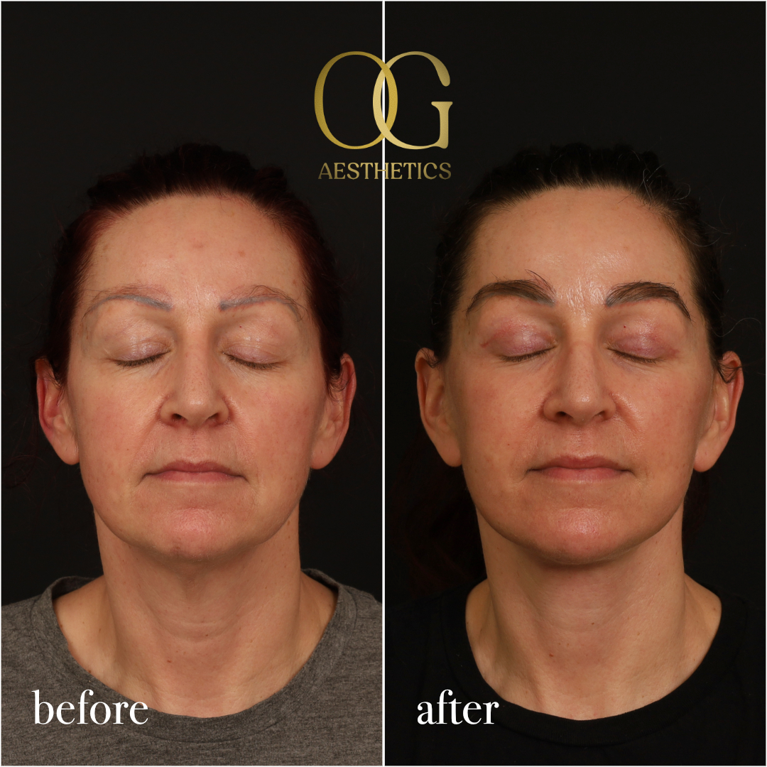 Fat Transfer Before & After Gallery - Patient 229052 - Image 4