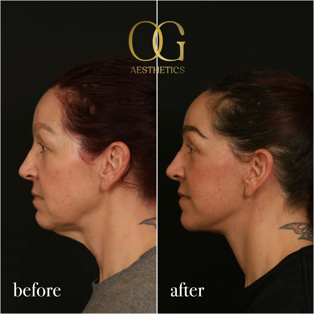 Fat Transfer Before & After Gallery - Patient 229052 - Image 8