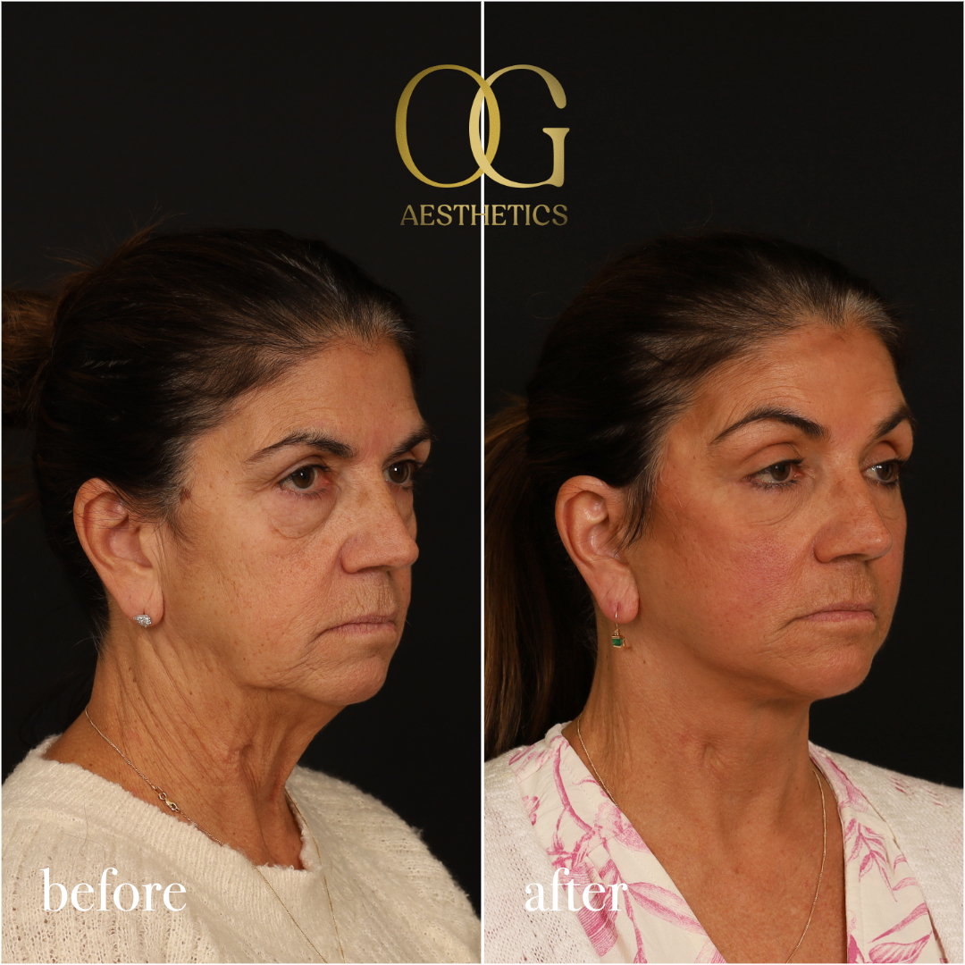 Brow Lift Before & After Gallery - Patient 215363 - Image 4
