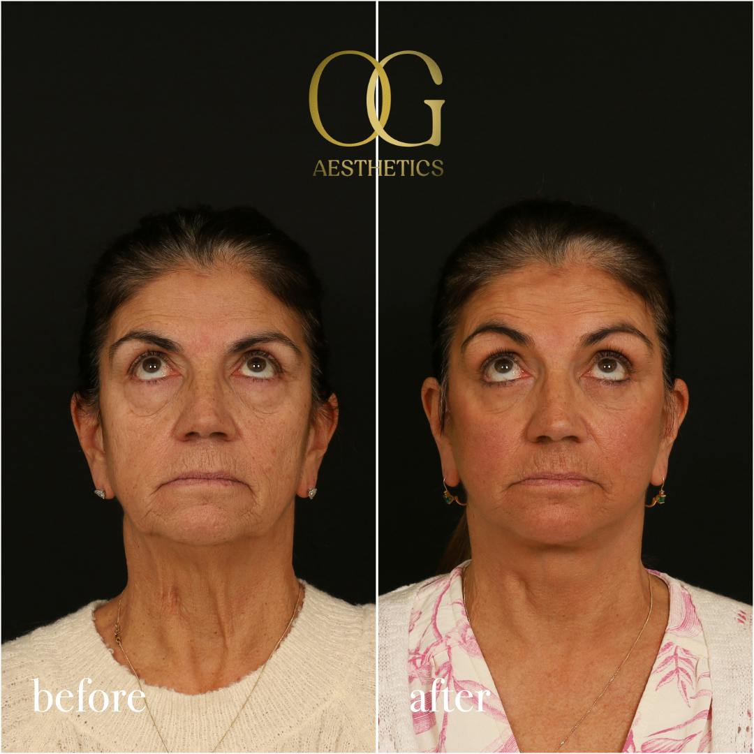 Blepharoplasty Before & After Gallery - Patient 216404 - Image 3
