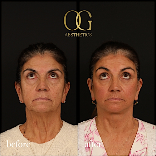 Blepharoplasty Before & After Gallery - Patient 216404 - Image 3