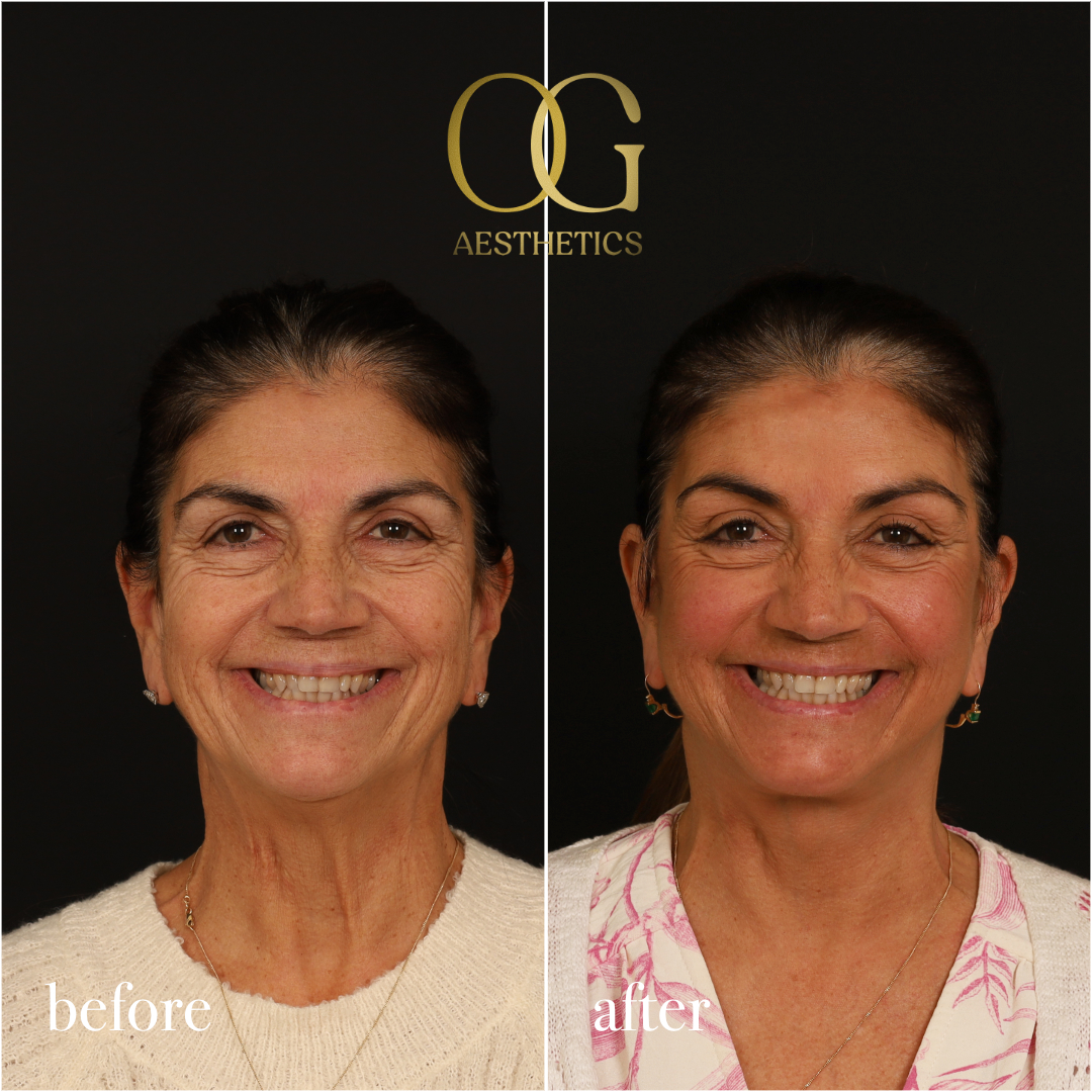 Brow Lift Before & After Gallery - Patient 215363 - Image 2