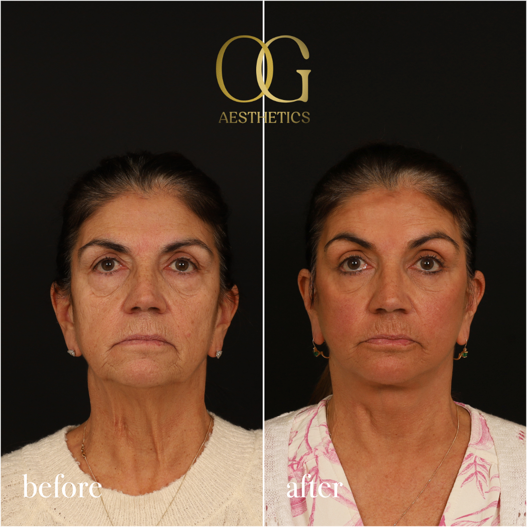 Brow Lift Before & After Gallery - Patient 215363 - Image 1