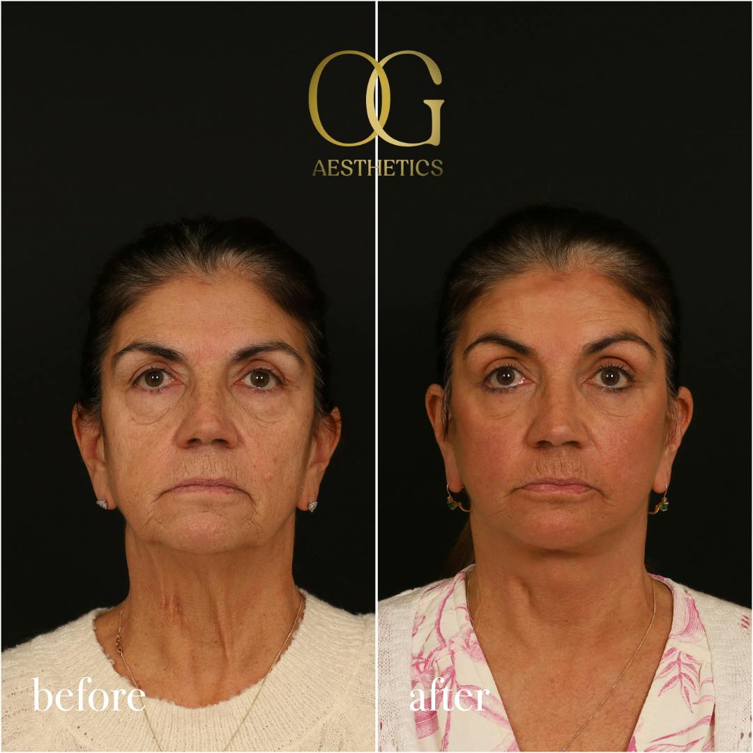 Blepharoplasty Before & After Gallery - Patient 216404 - Image 1