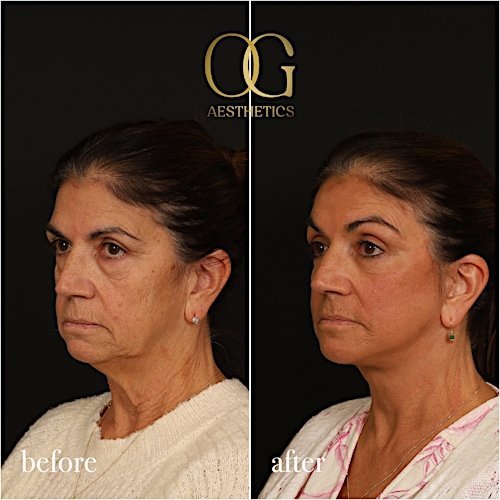 Blepharoplasty Before & After Gallery - Patient 216404 - Image 6