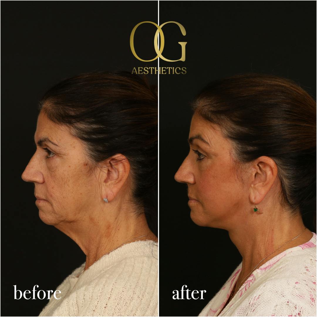 Blepharoplasty Before & After Gallery - Patient 216404 - Image 7