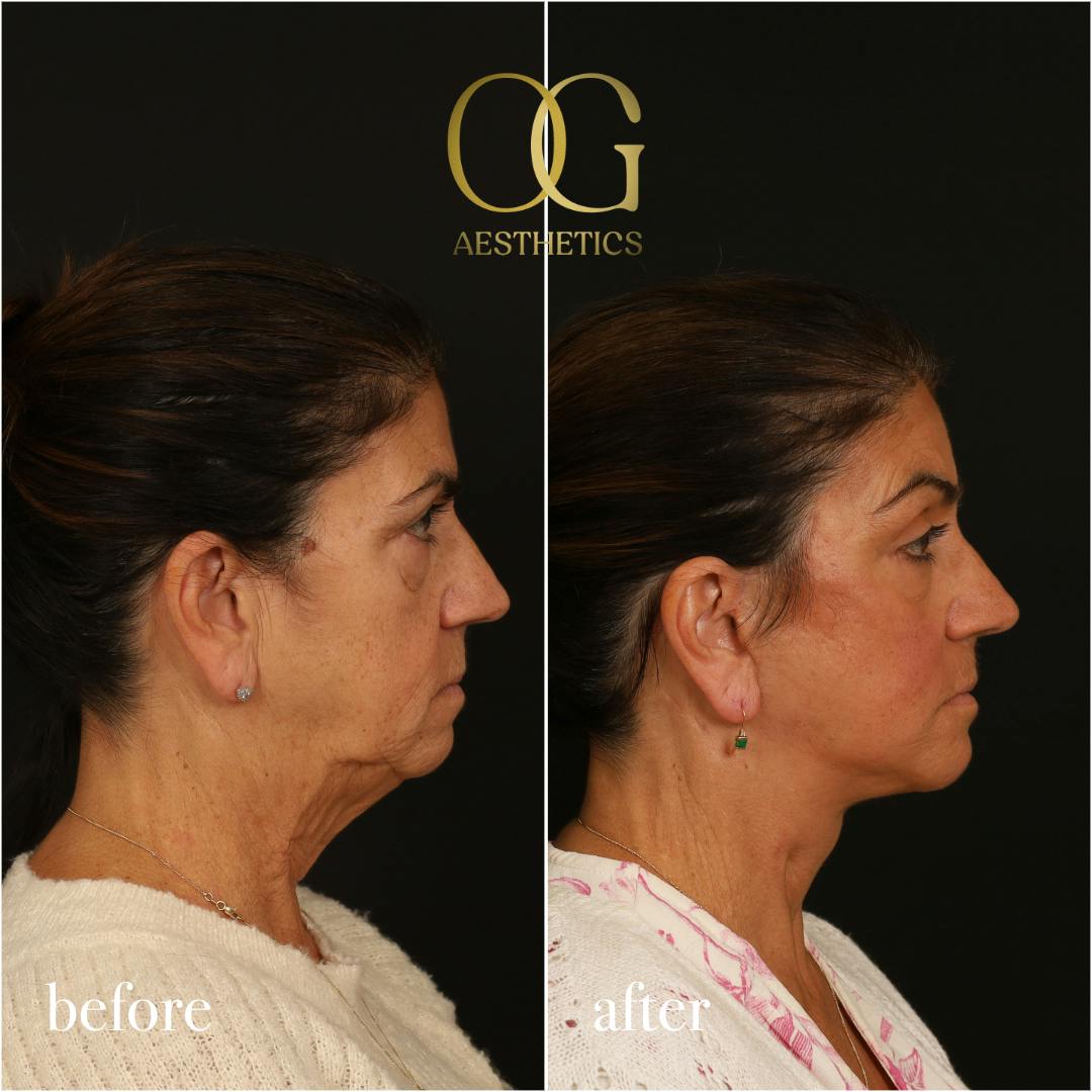 Blepharoplasty Before & After Gallery - Patient 216404 - Image 5