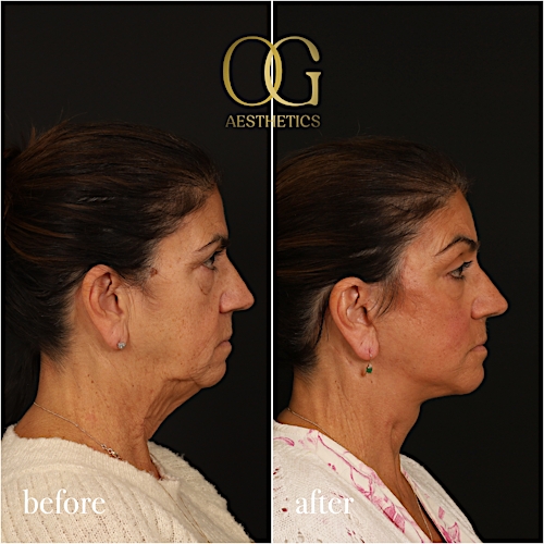 Blepharoplasty Before & After Gallery - Patient 216404 - Image 5