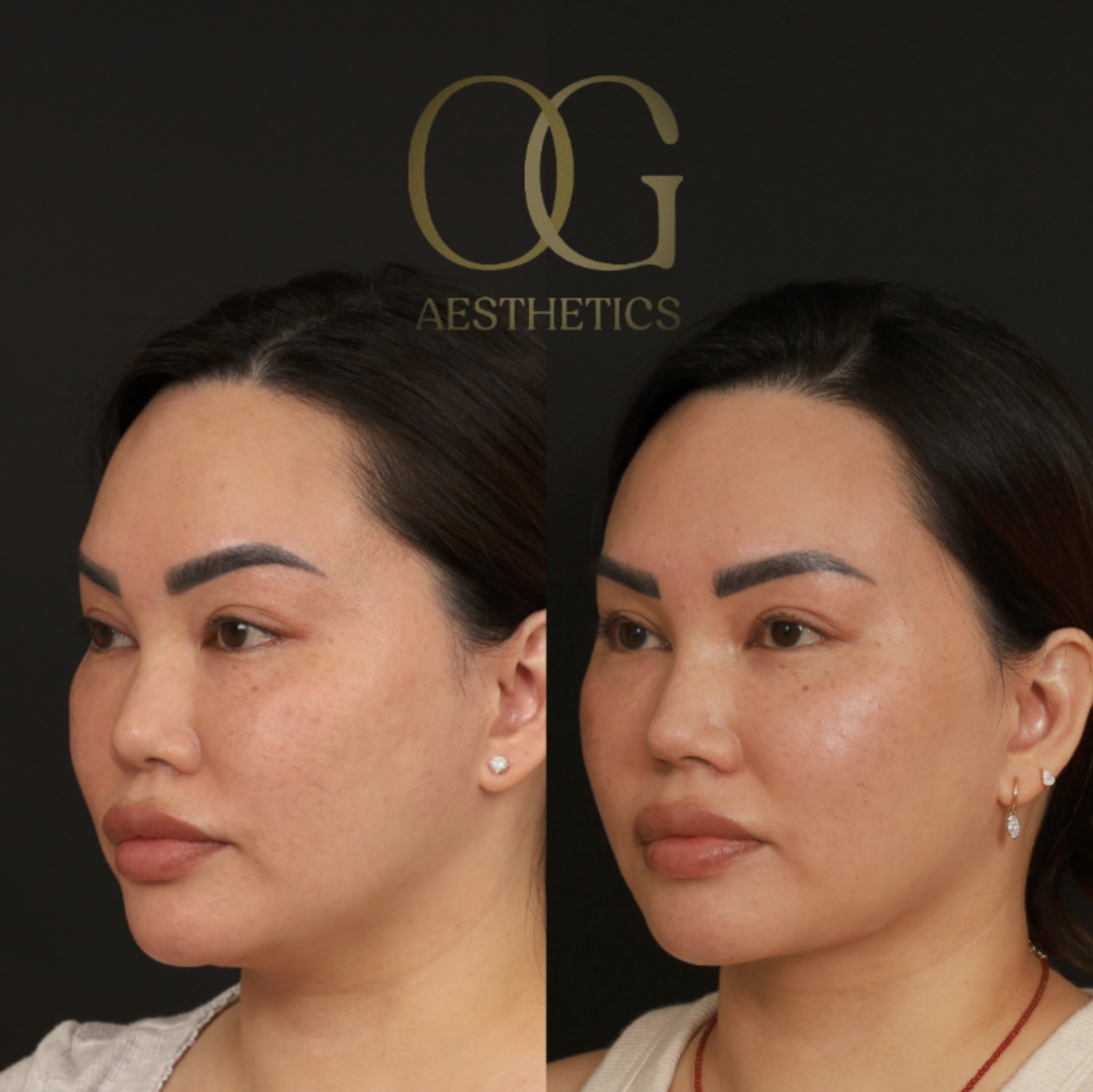 Submental Liposuction Before & After Gallery - Patient 446026 - Image 2