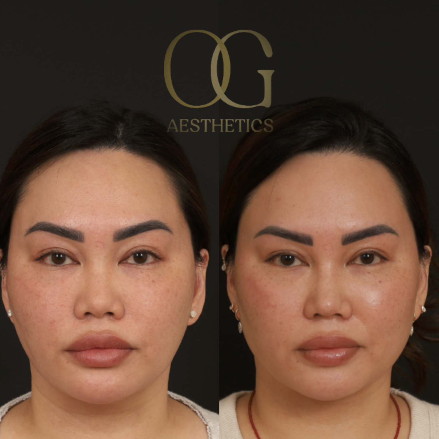 Submental Liposuction Before & After Gallery - Patient 446026 - Image 5
