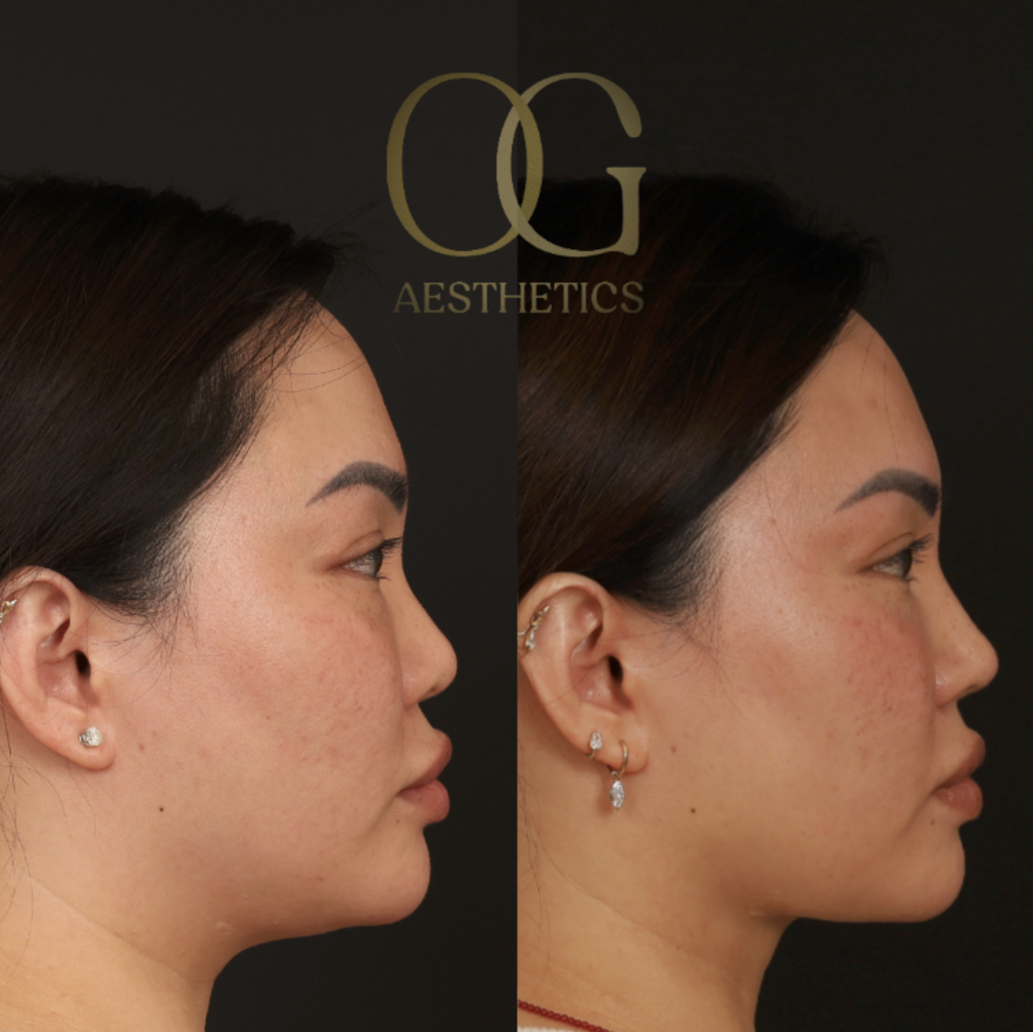 Submental Liposuction Before & After Gallery - Patient 446026 - Image 1
