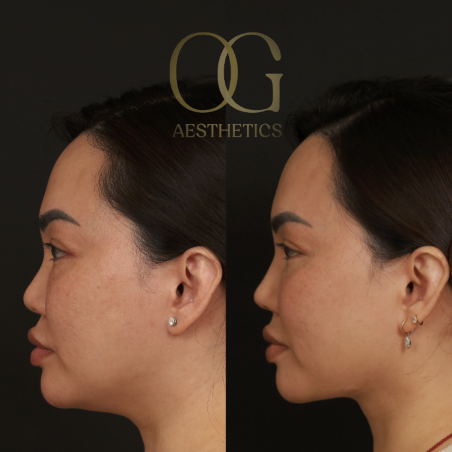 Submental Liposuction Before & After Gallery - Patient 446026 - Image 3