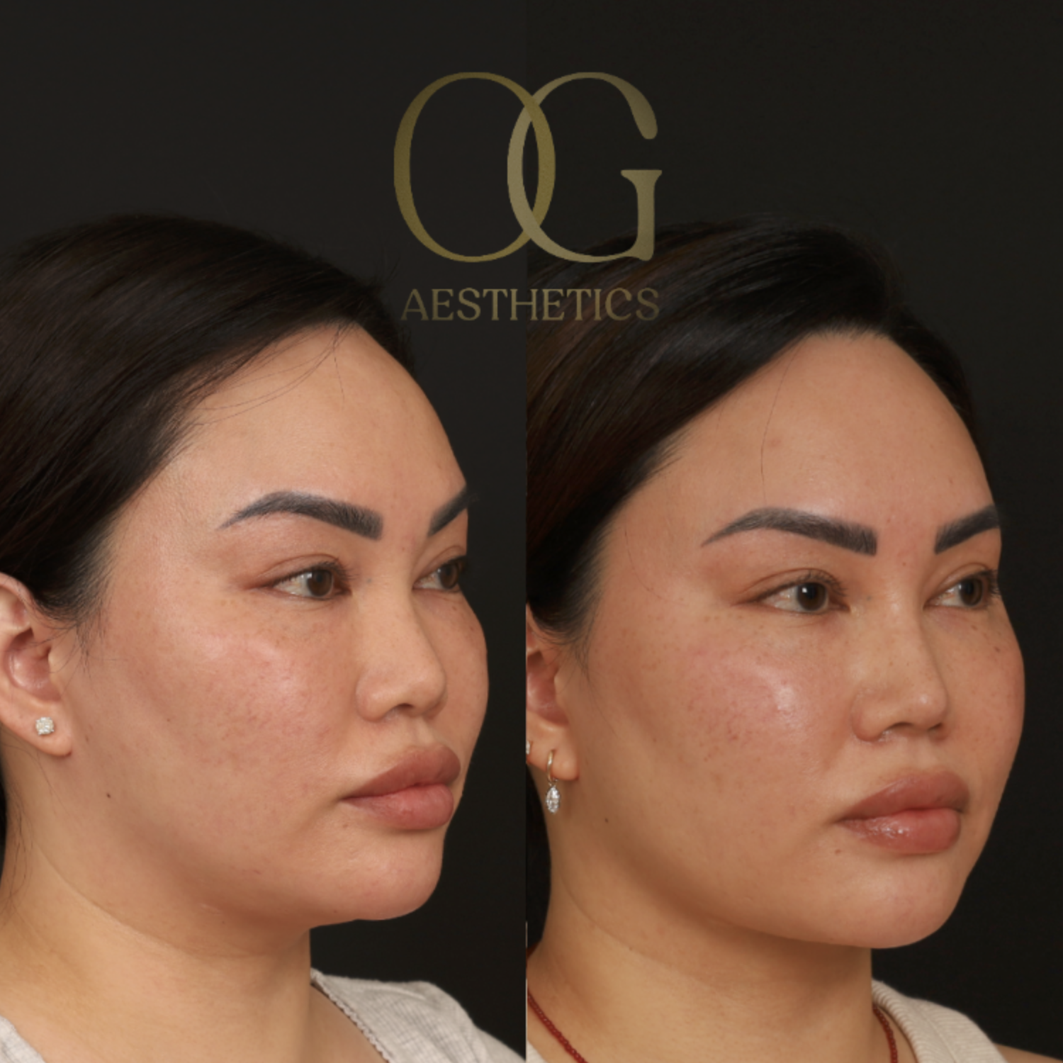 Submental Liposuction Before & After Gallery - Patient 446026 - Image 4