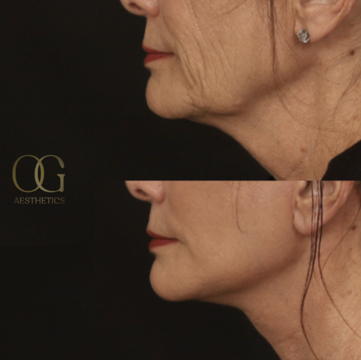 Neck Lift Before & After Gallery - Patient 121062 - Image 3