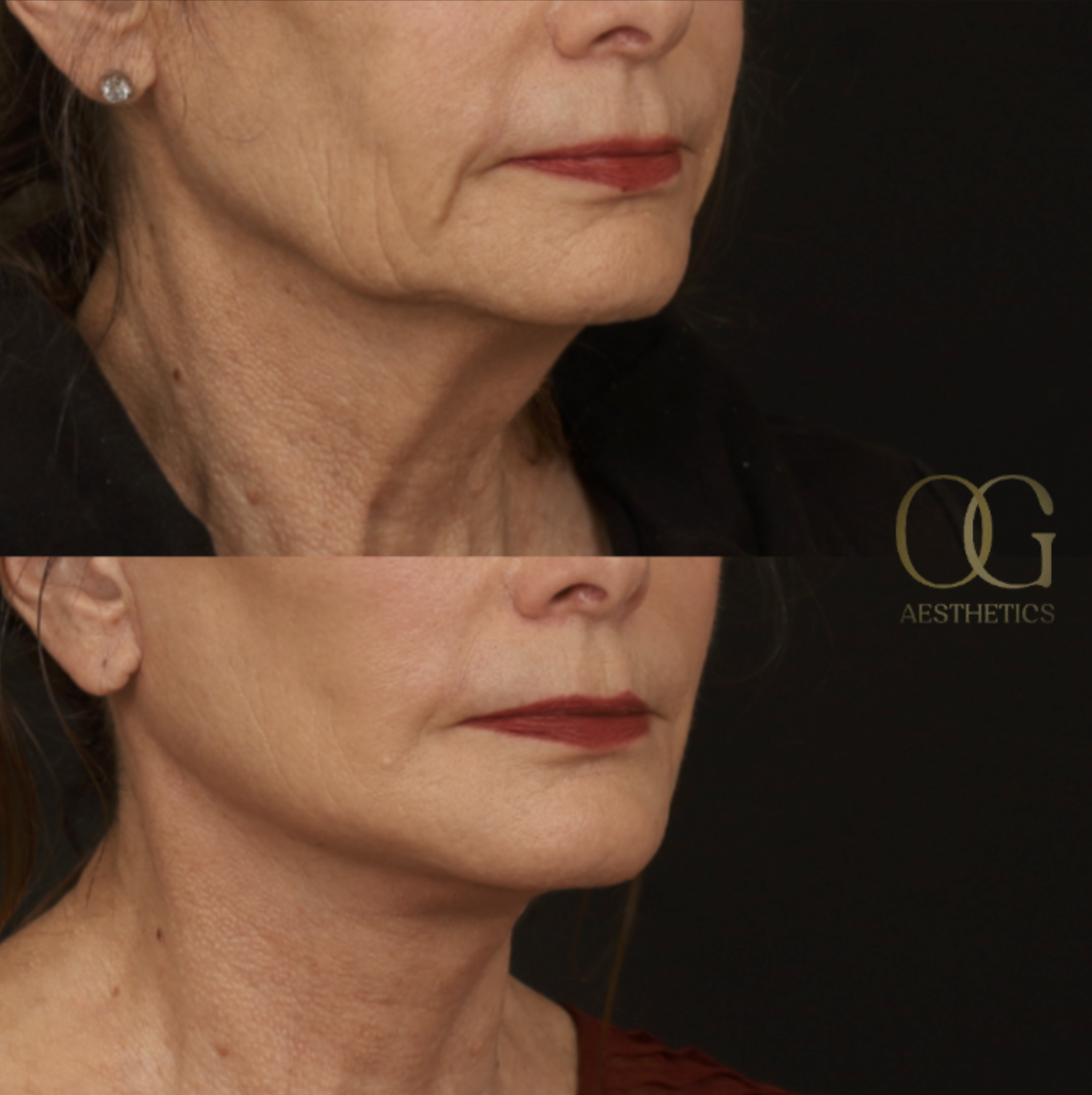 Neck Lift Before & After Gallery - Patient 121062 - Image 2