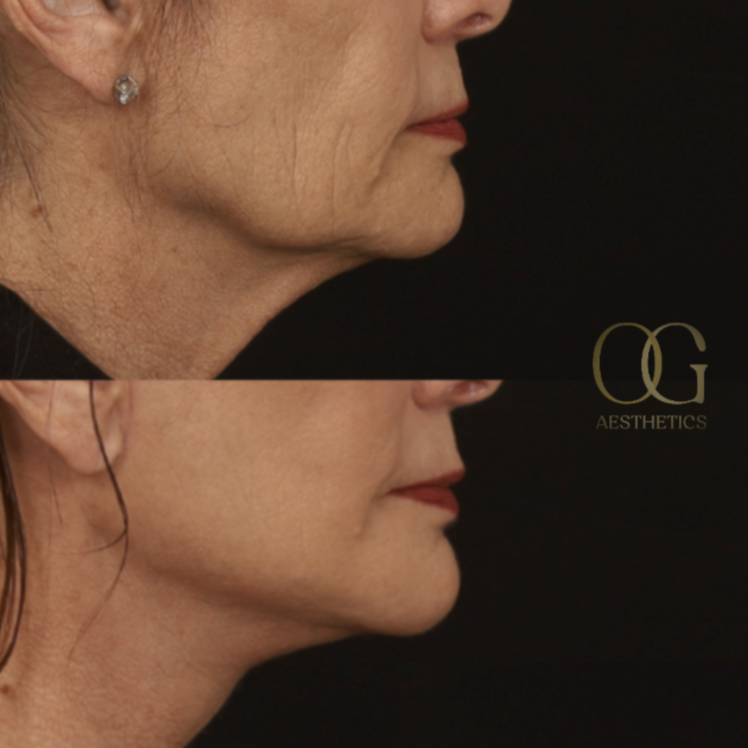 Neck Lift Before & After Gallery - Patient 121062 - Image 1