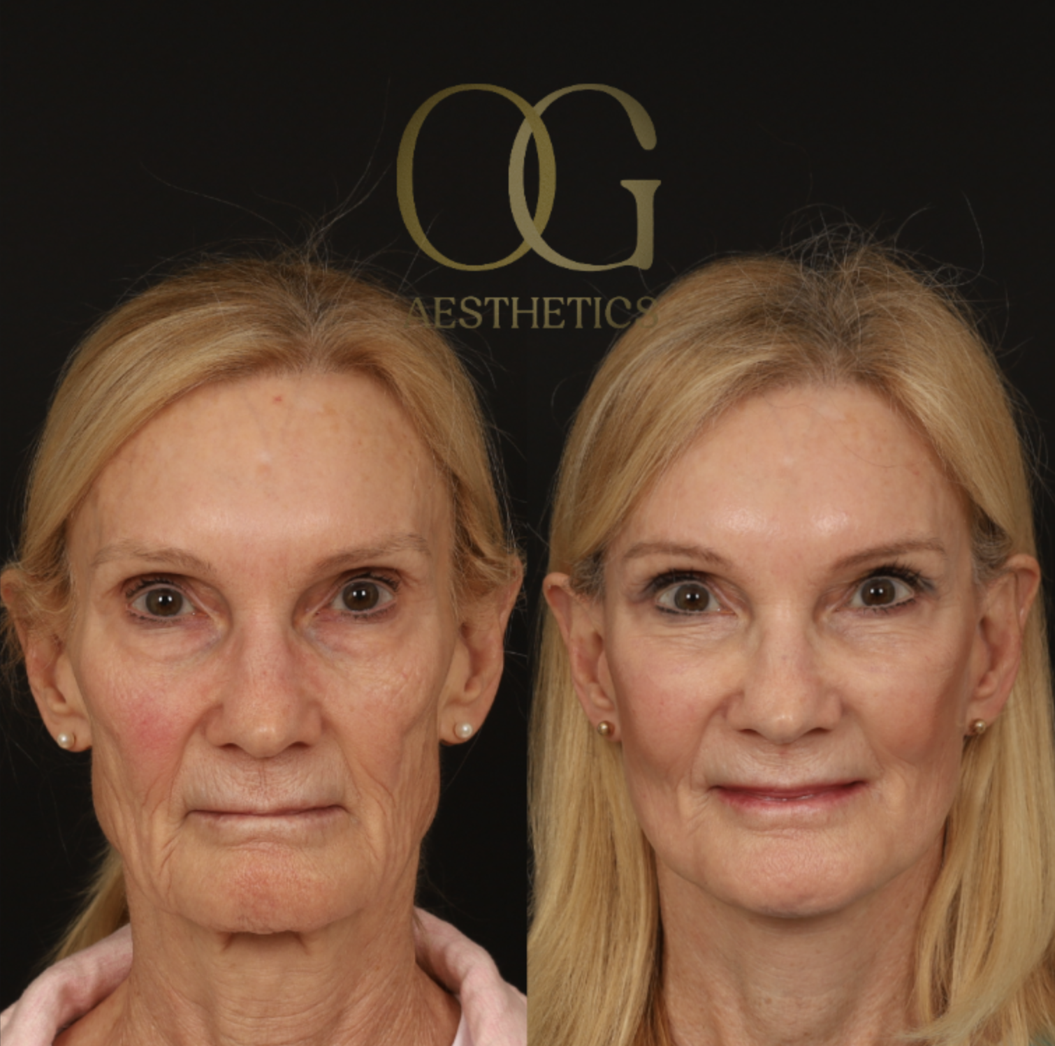 Blepharoplasty Before & After Gallery - Patient 173627 - Image 1