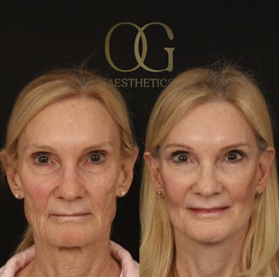 Blepharoplasty Before & After Gallery - Patient 173627 - Image 1