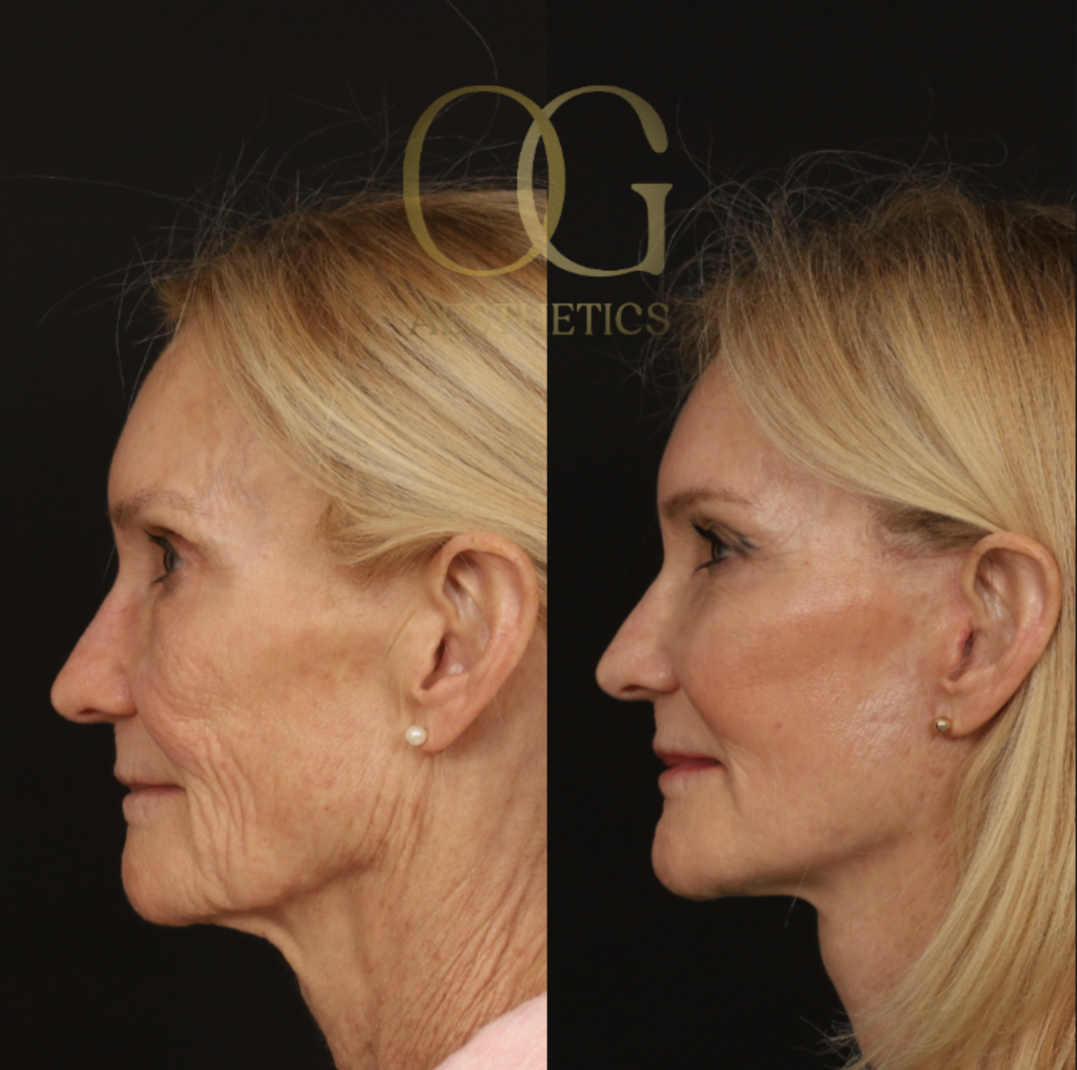 Blepharoplasty Before & After Gallery - Patient 173627 - Image 5