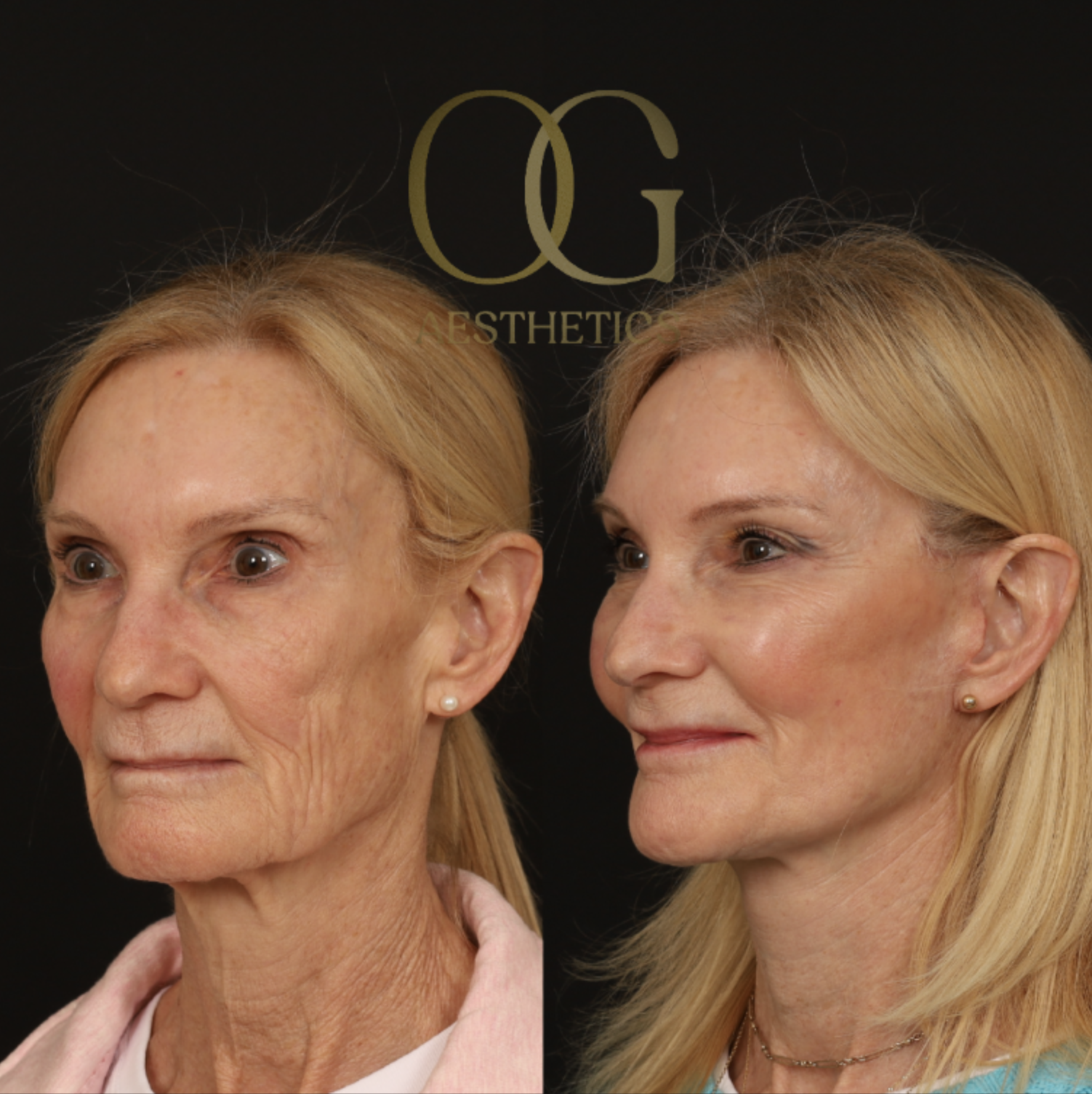 Blepharoplasty Before & After Gallery - Patient 173627 - Image 4