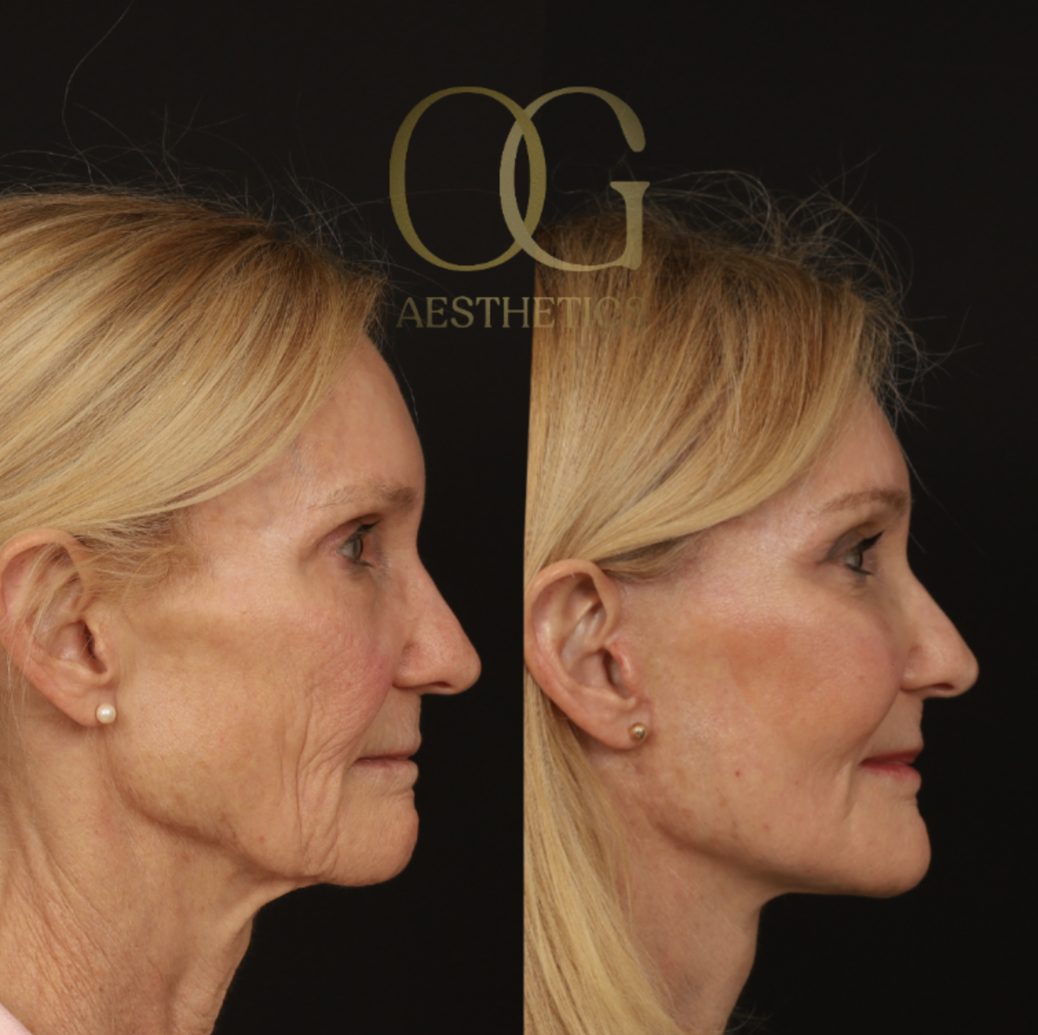 Blepharoplasty Before & After Gallery - Patient 173627 - Image 3