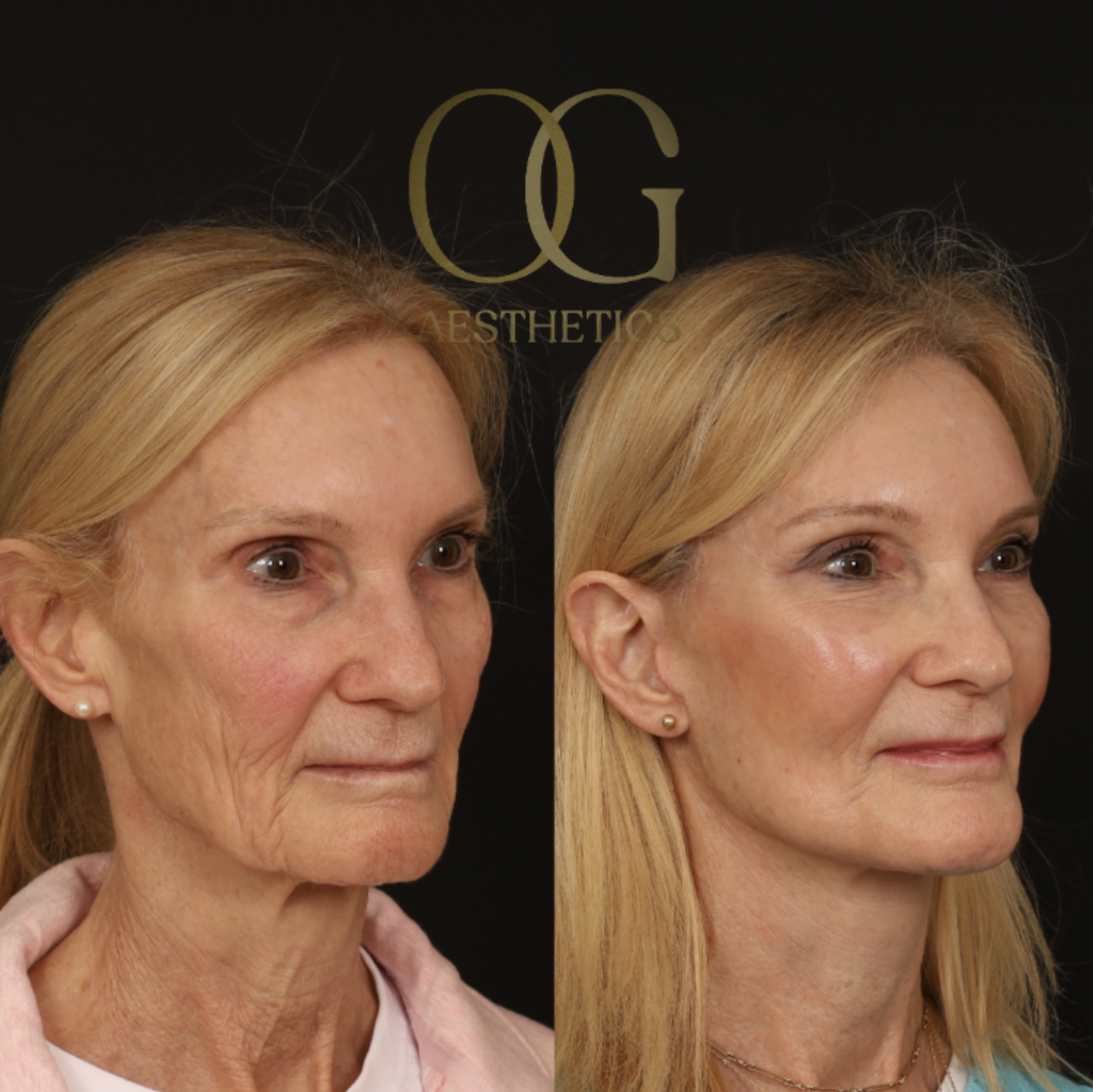 Blepharoplasty Before & After Gallery - Patient 173627 - Image 2