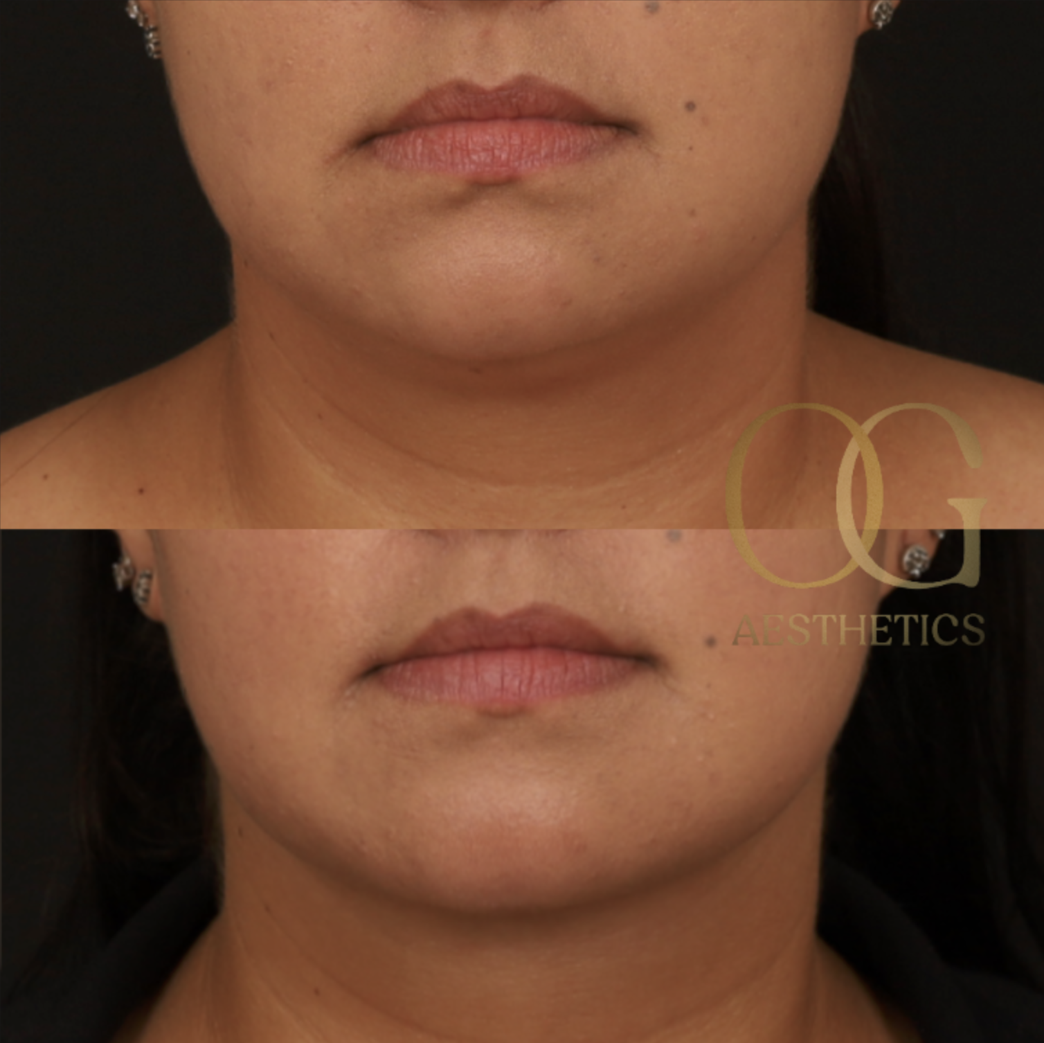 Submental Liposuction Before & After Gallery - Patient 922797 - Image 5