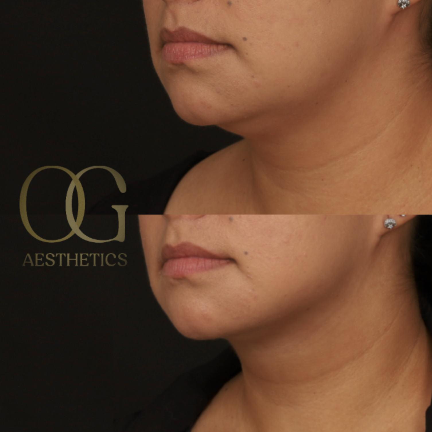 Submental Liposuction Before & After Gallery - Patient 922797 - Image 3
