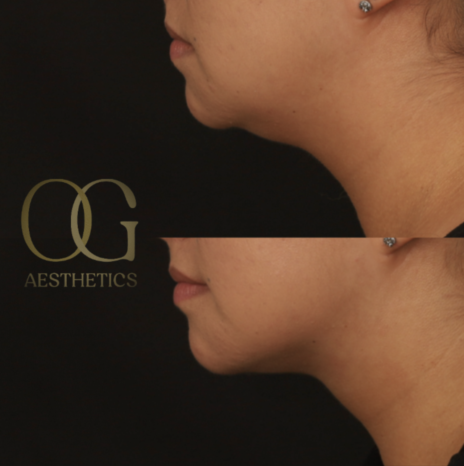 Submental Liposuction Before & After Gallery - Patient 922797 - Image 4