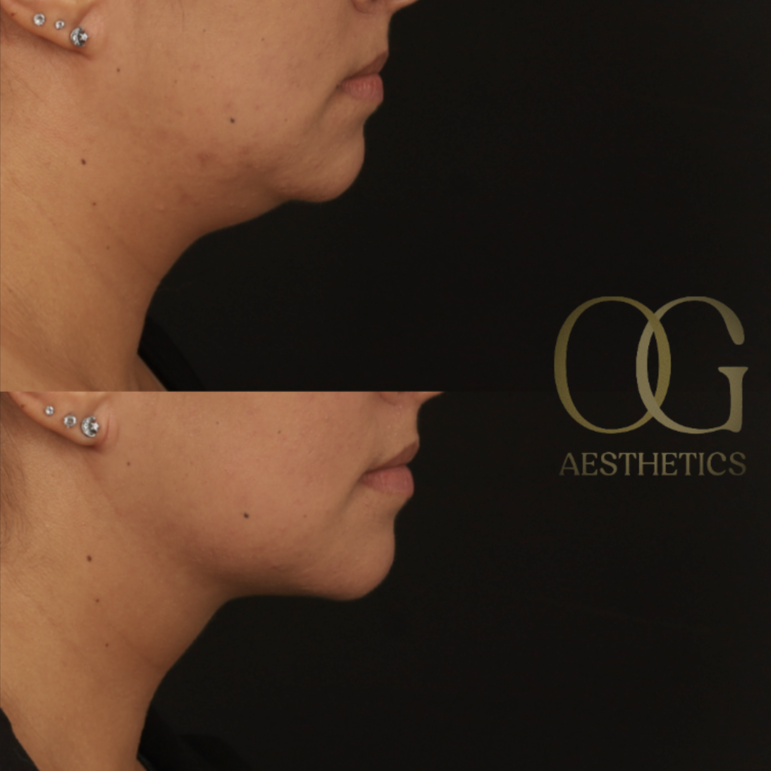 Submental Liposuction Before & After Gallery - Patient 922797 - Image 1