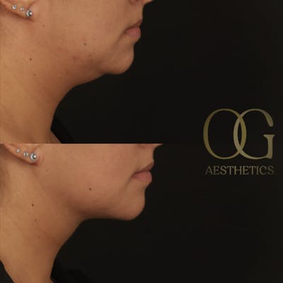 Submental Liposuction Before & After Gallery - Patient 922797 - Image 1