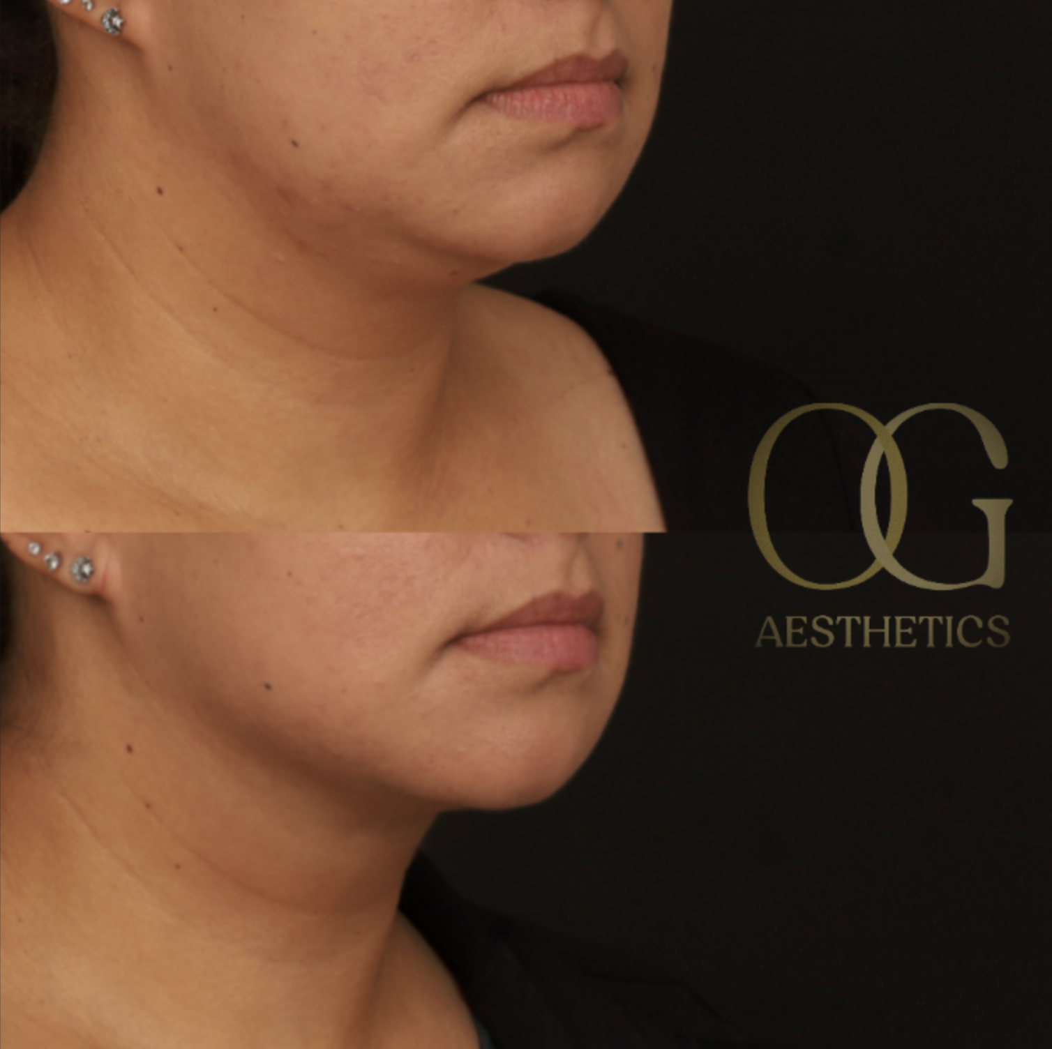 Submental Liposuction Before & After Gallery - Patient 922797 - Image 2