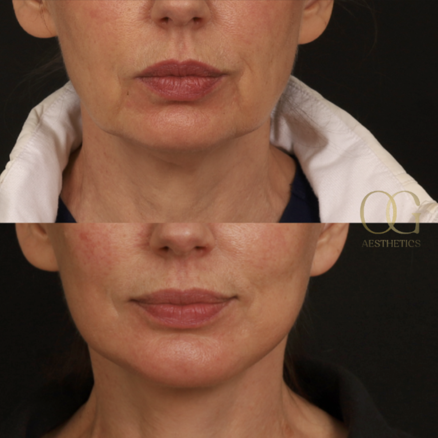 Facelift Before & After Gallery - Patient 181270 - Image 3