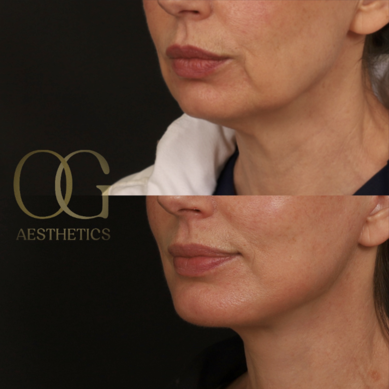 Facelift Before & After Gallery - Patient 181270 - Image 4