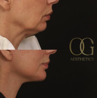 Neck Lift Before & After Gallery - Patient 351936 - Image 1