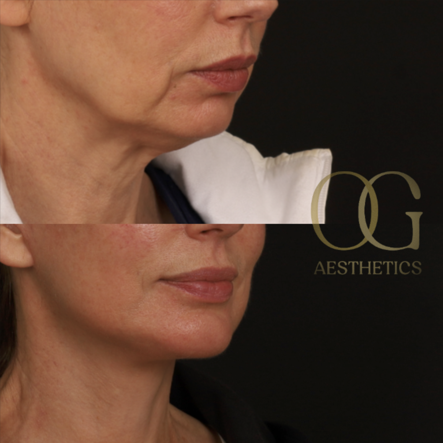 Facelift Before & After Gallery - Patient 181270 - Image 2