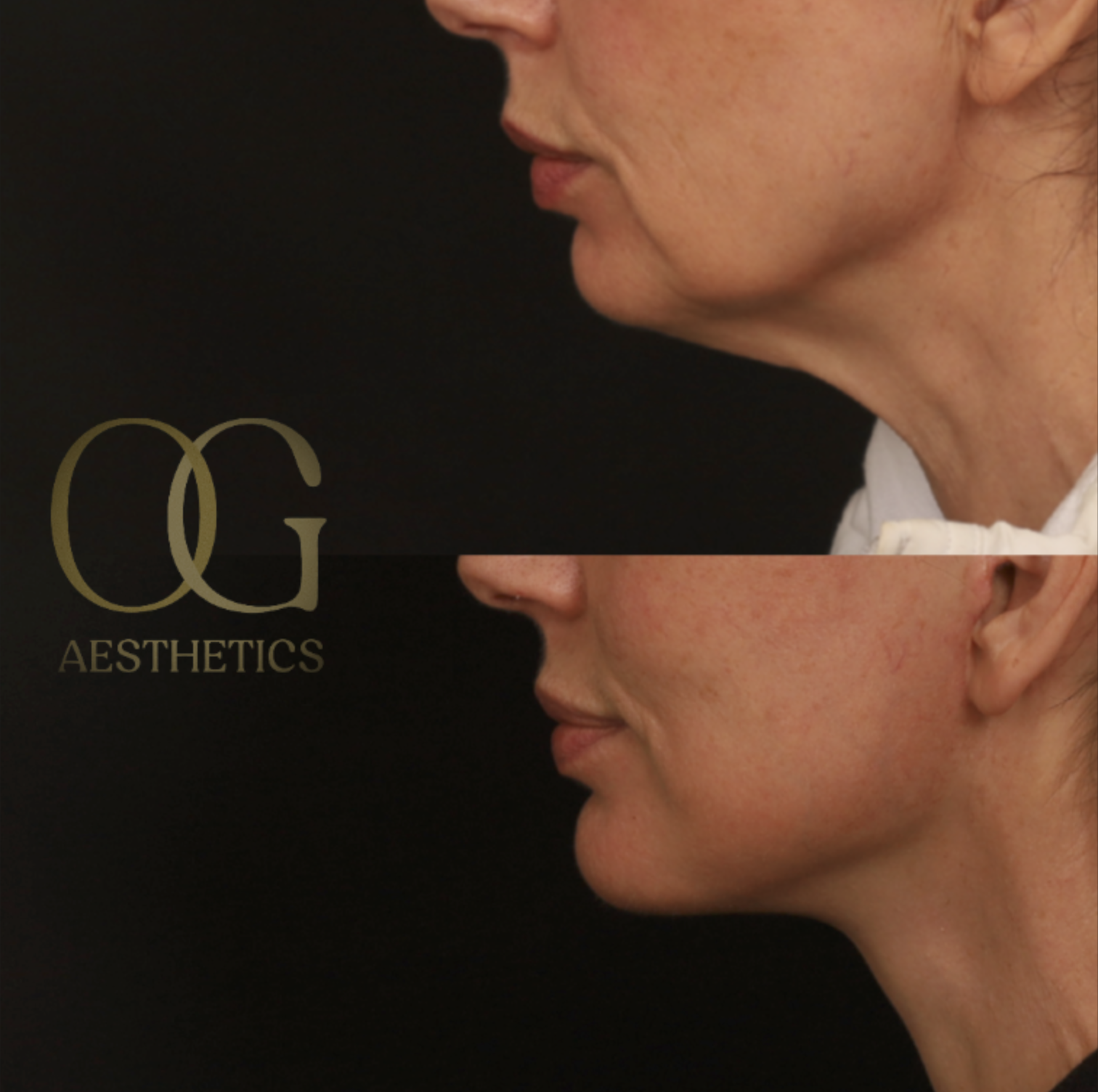 Facelift Before & After Gallery - Patient 181270 - Image 5