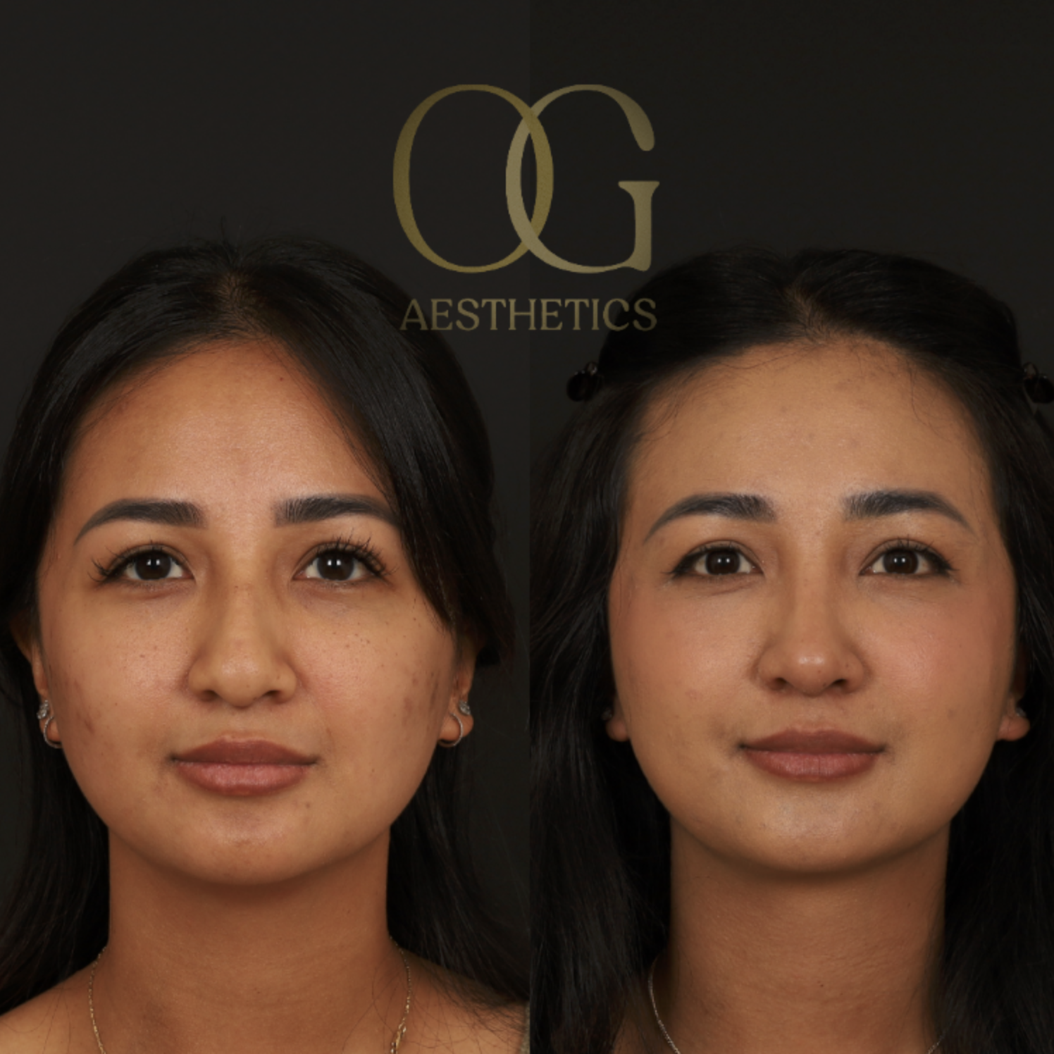 Rhinoplasty Before & After Gallery - Patient 703370 - Image 5