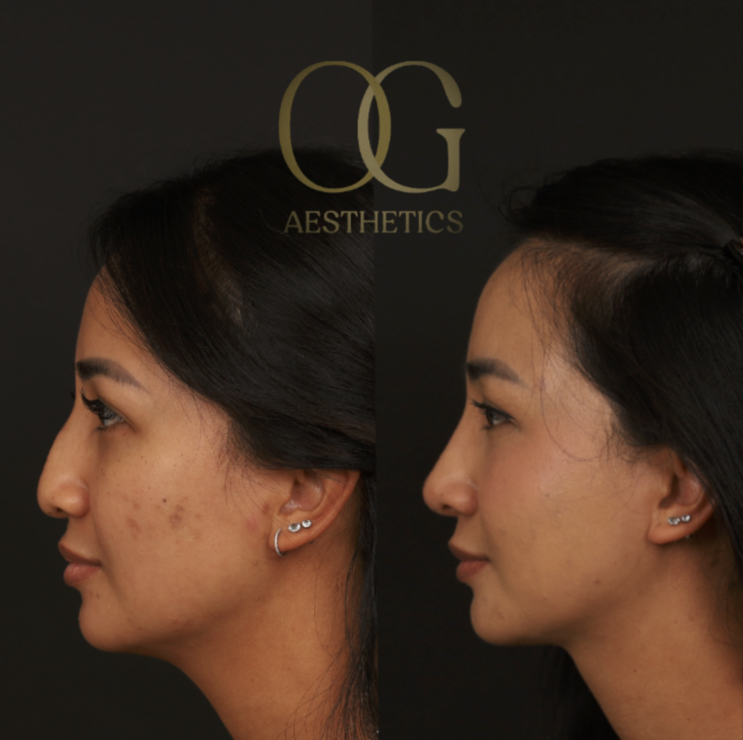 Rhinoplasty Before & After Gallery - Patient 703370 - Image 4