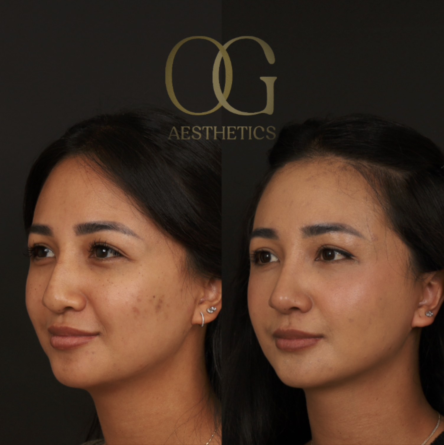 Rhinoplasty Before & After Gallery - Patient 703370 - Image 3