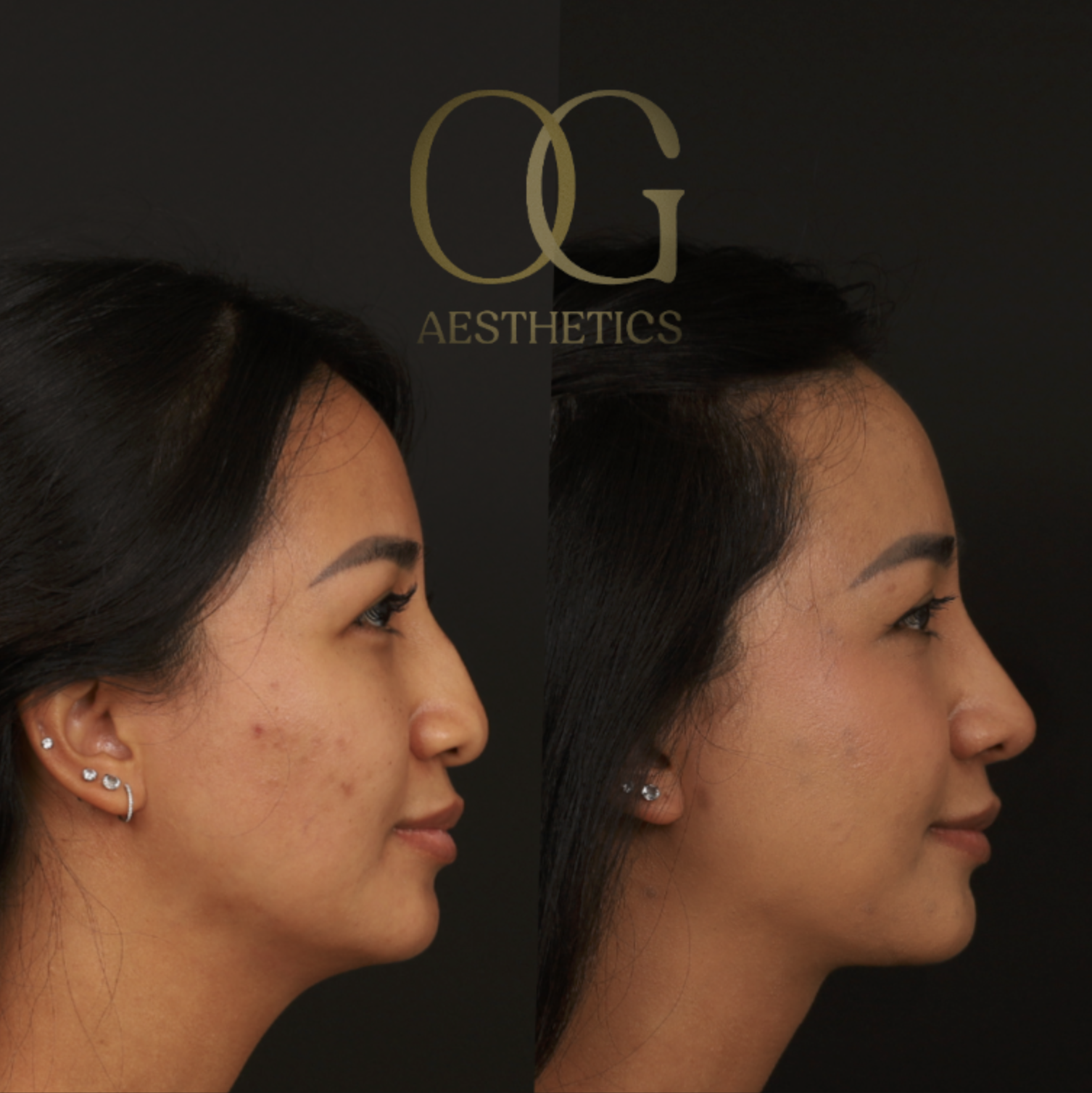 Rhinoplasty Before & After Gallery - Patient 703370 - Image 1
