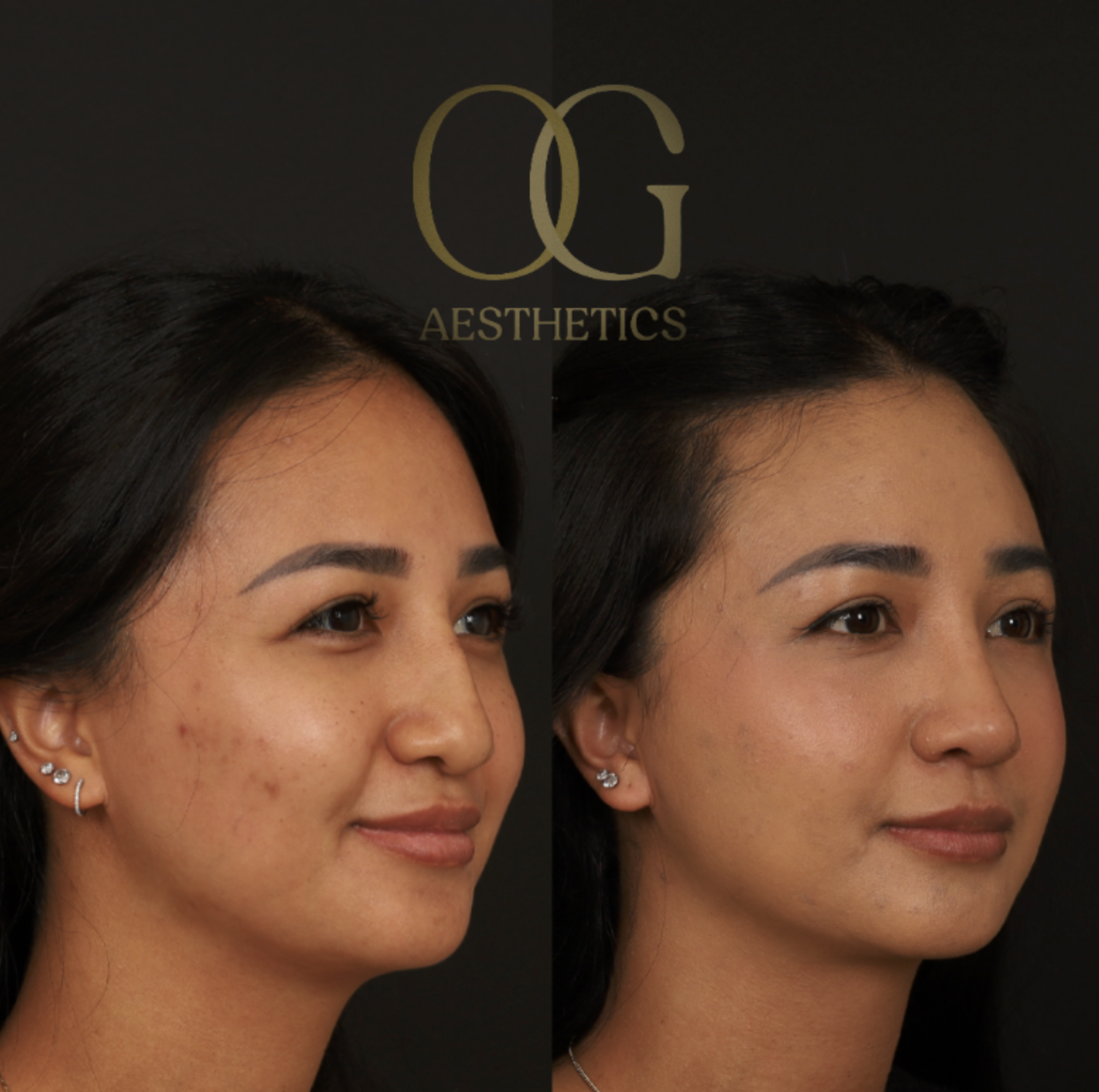 Rhinoplasty Before & After Gallery - Patient 703370 - Image 2
