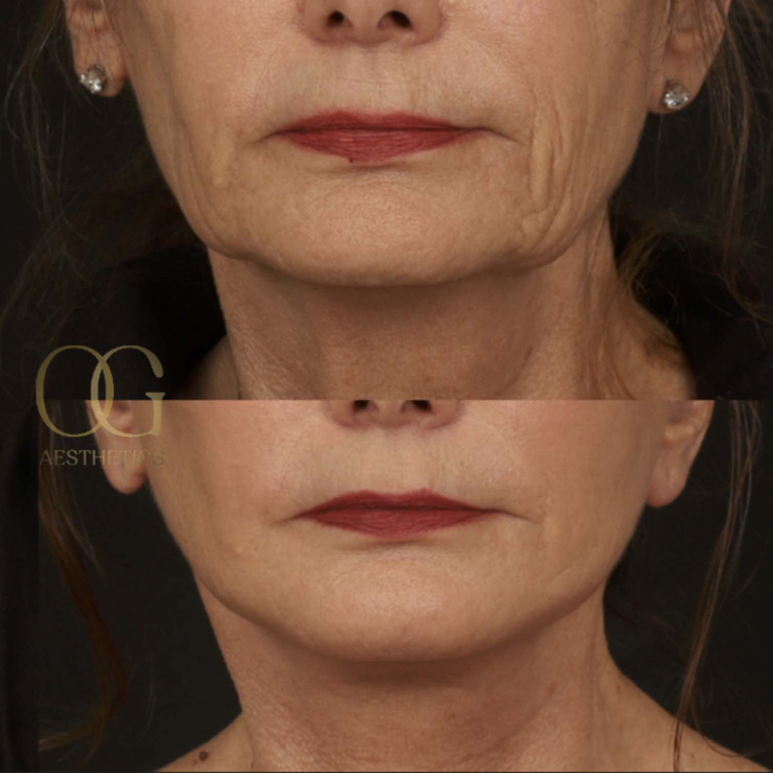 Neck Lift Before & After Gallery - Patient 214400 - Image 1