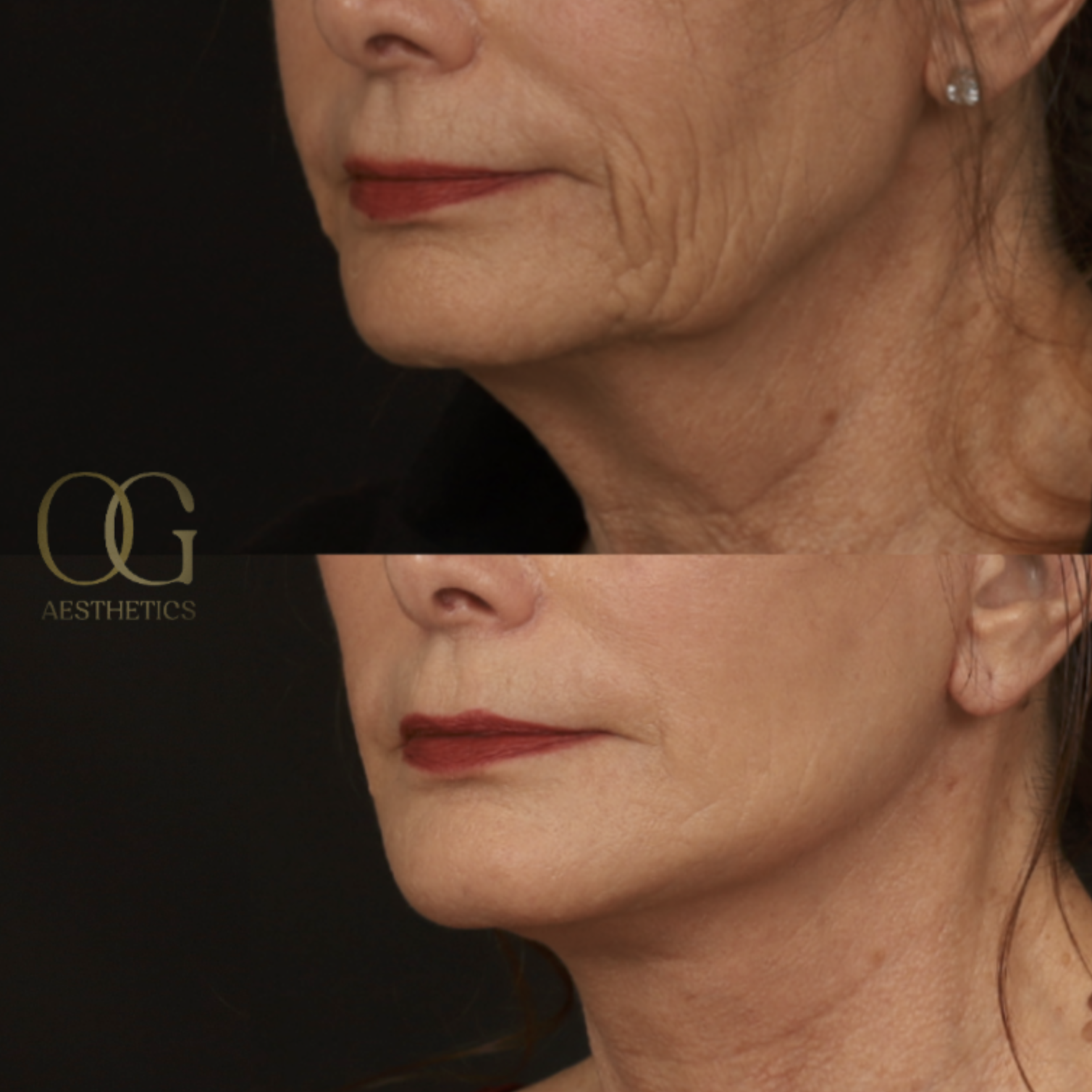 Neck Lift Before & After Gallery - Patient 214400 - Image 4