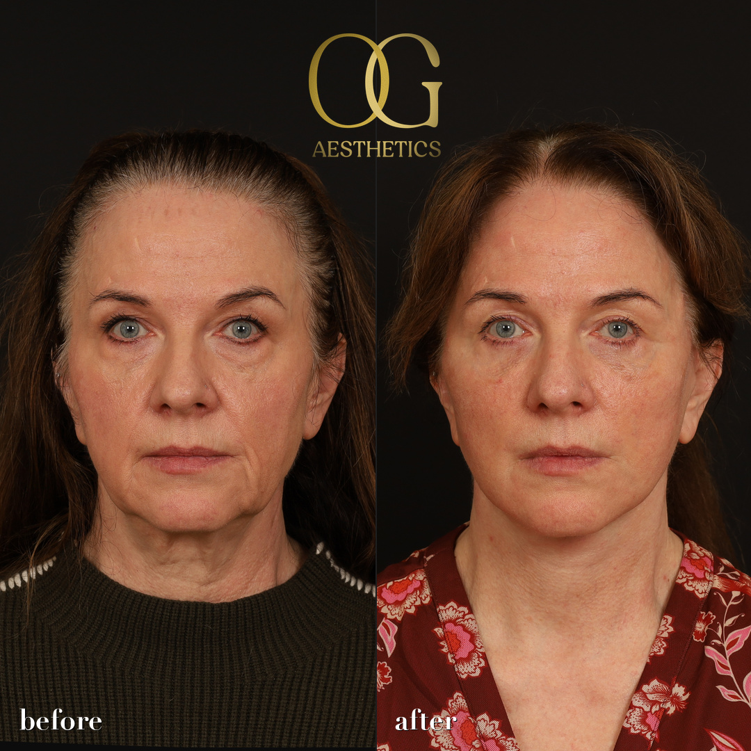 Facelift Before & After Gallery - Patient 330678 - Image 1