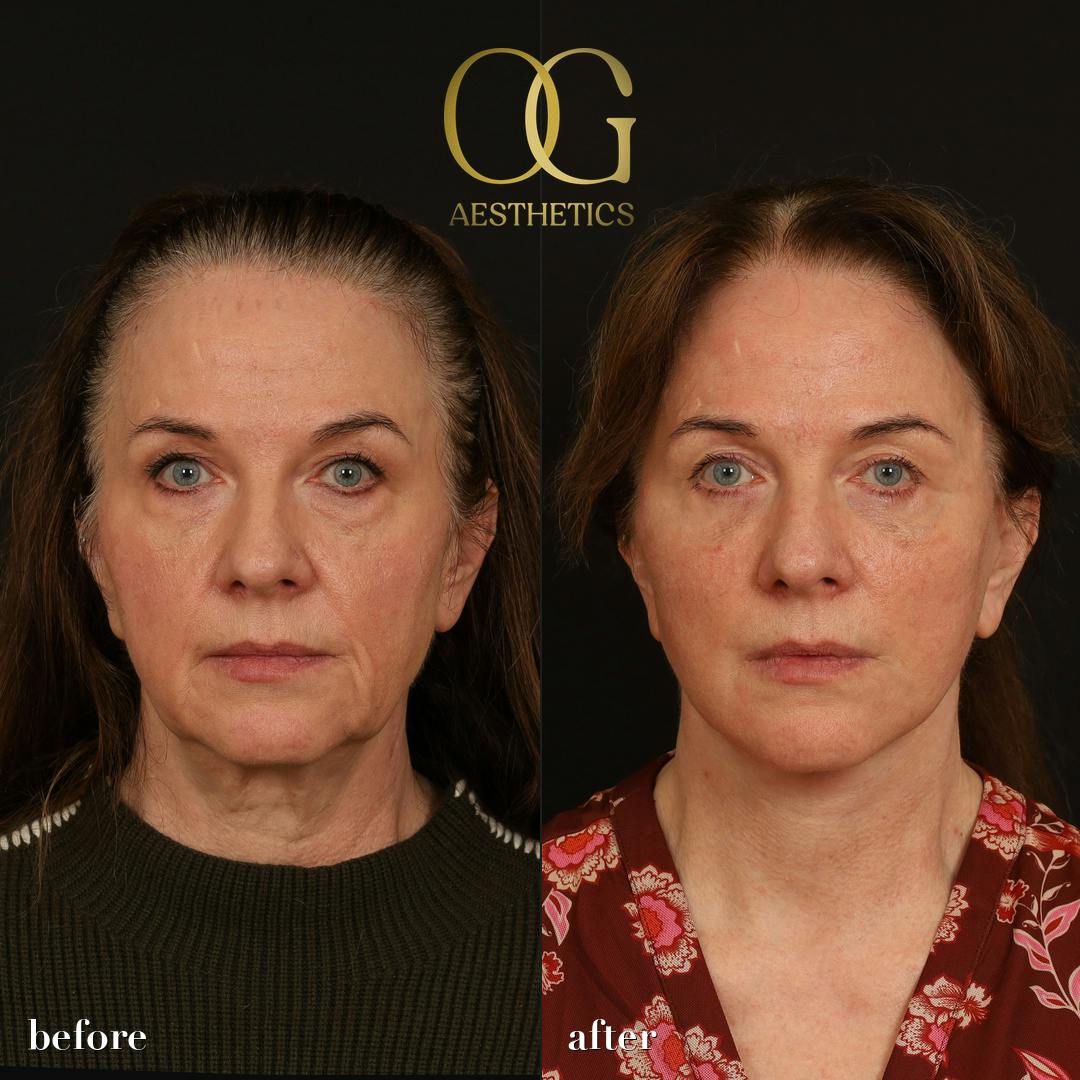 Facelift Before & After Gallery - Patient 330678 - Image 1