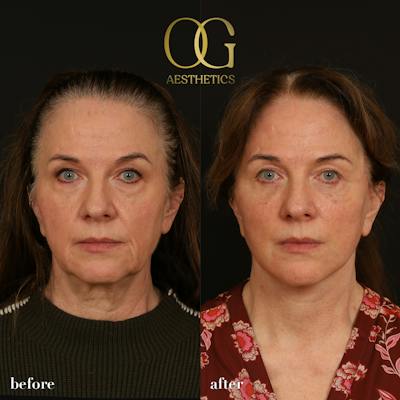 Facelift Before & After Gallery - Patient 330678 - Image 1