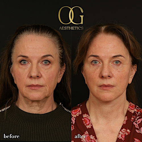 Facelift Before & After Gallery - Patient 330678 - Image 1