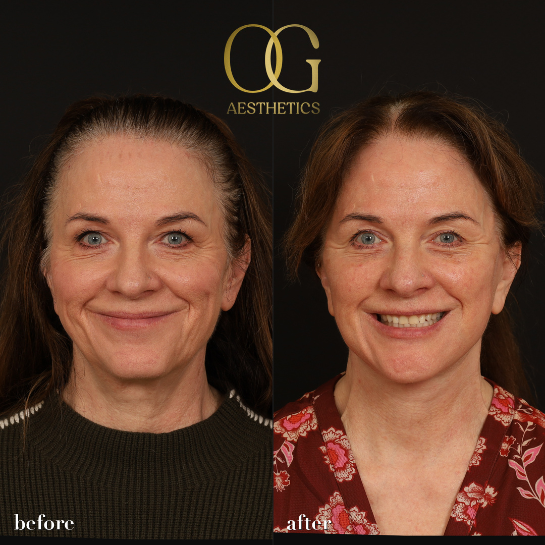 Facelift Before & After Gallery - Patient 330678 - Image 2